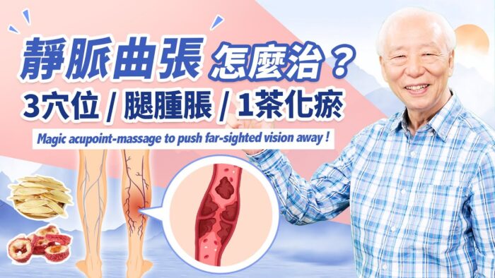 靜脈曲張可致栓塞命危 1動作促血液回流 中醫4招改善